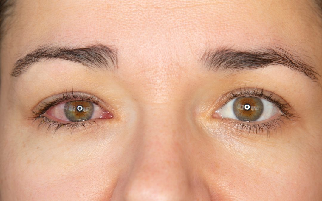 Can Adults Get Pink Eye?