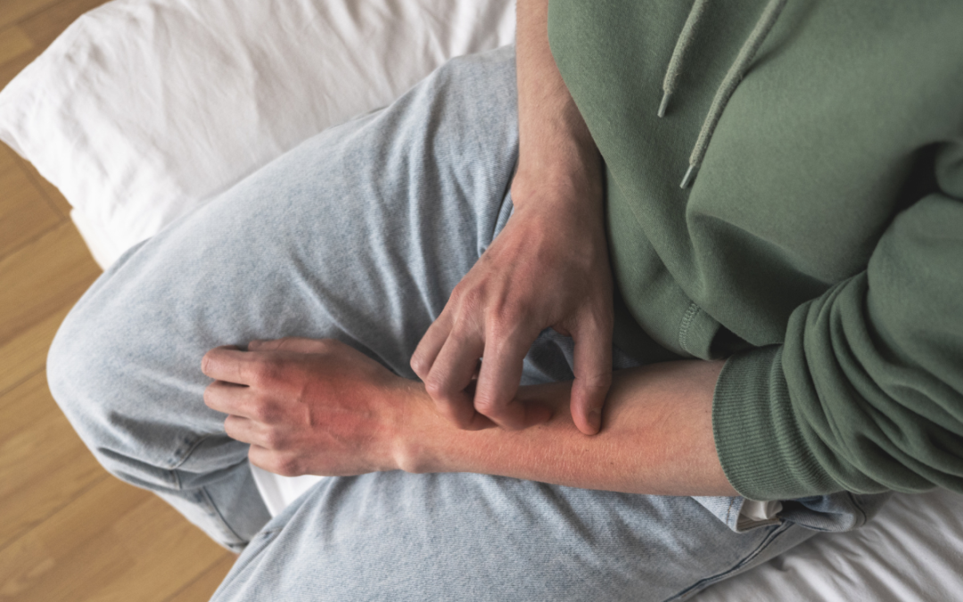 How to Identify and Treat Heat Rash