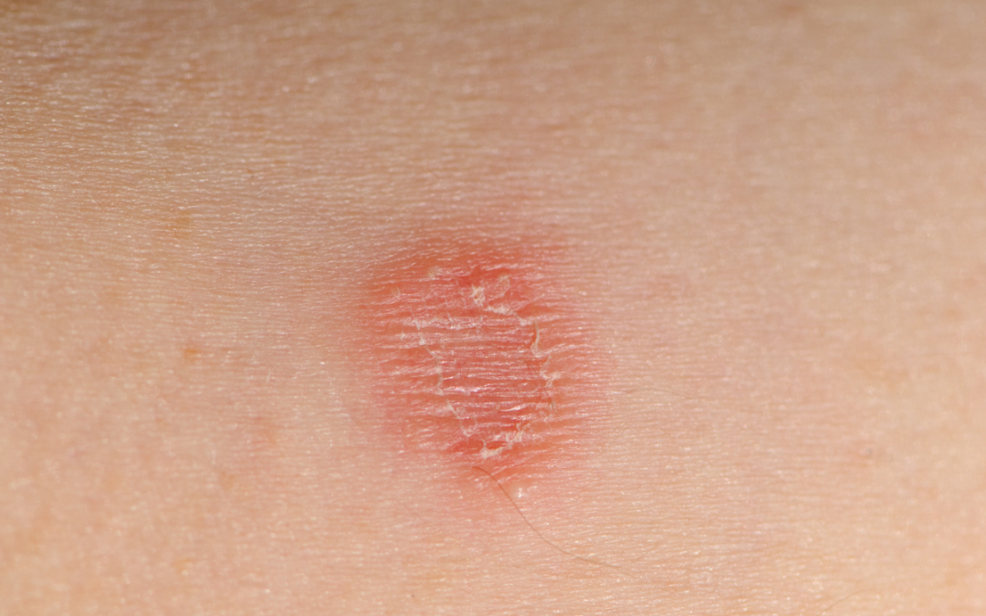How To Identify Ringworm