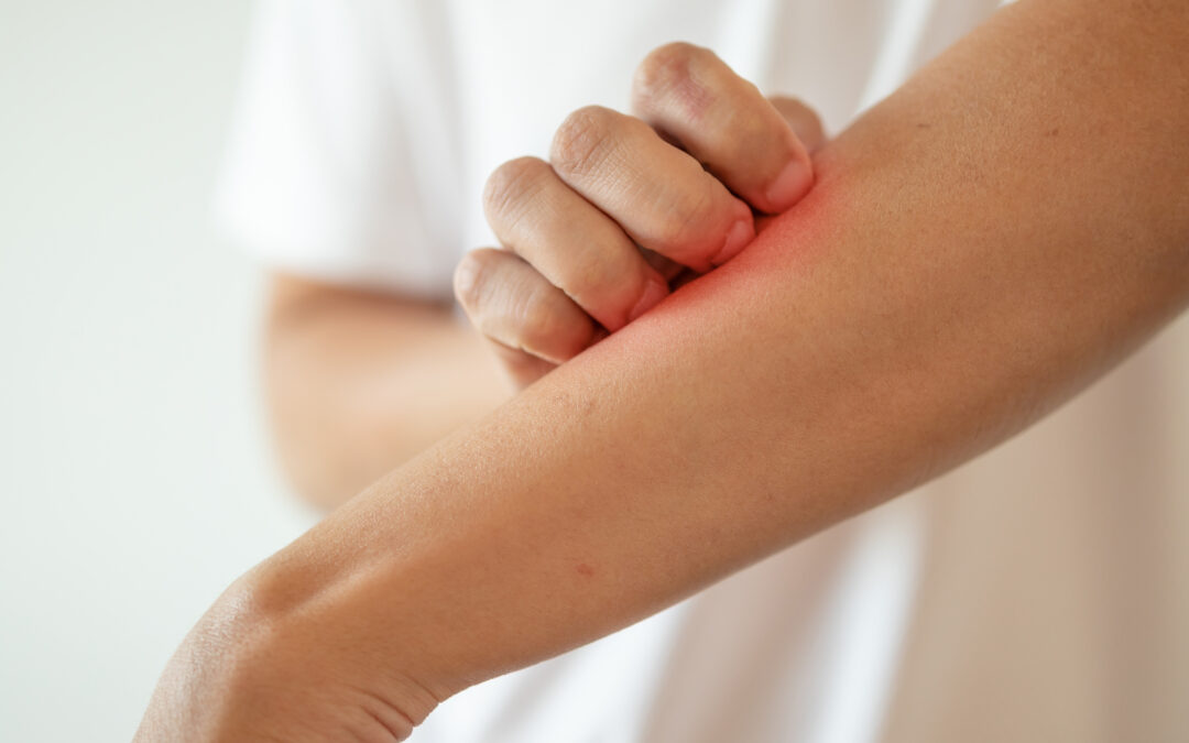 Dry Skin Explained by AFC Farragut